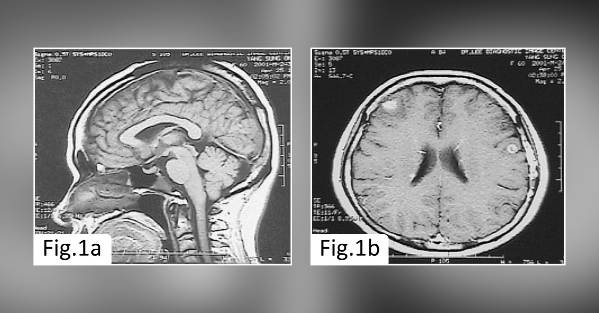 An Unusual Presentation of Gastric Cancer