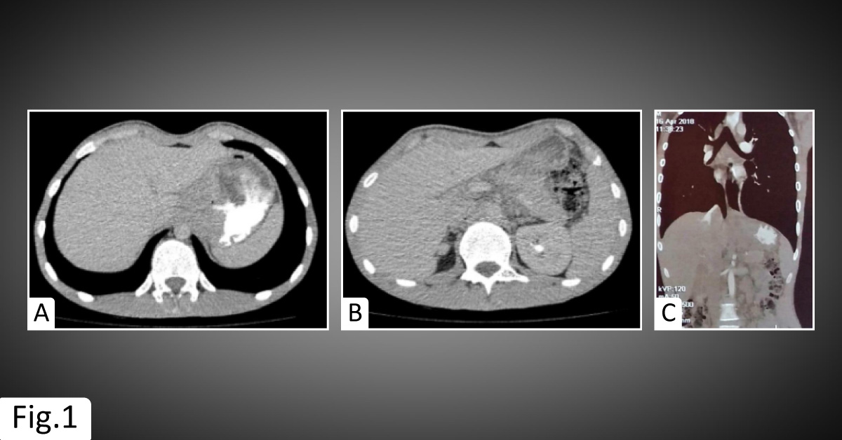 A Rare Clinical Manifestation of Gastric Cancer in a Young Patient