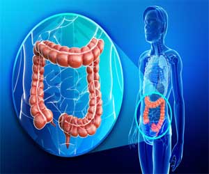 Innovative Easy-to-use Blood Test Shows Promise For Effective Colorectal Cancer Screening