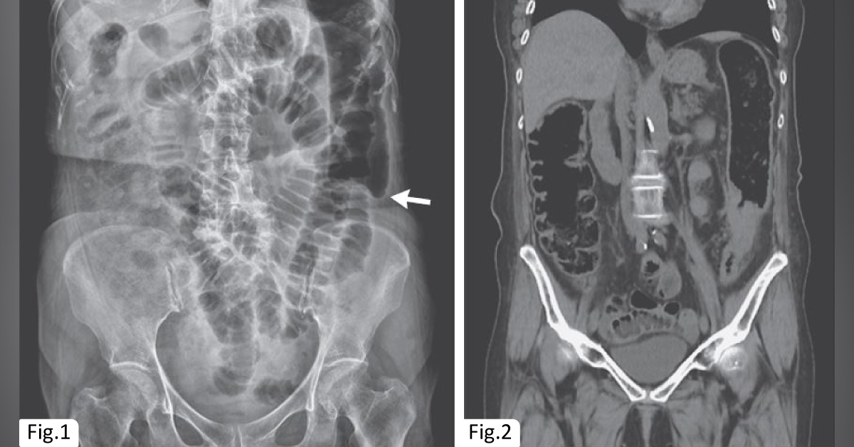 An Elderly Woman with Persistent Pain in the Lower Abdomen
