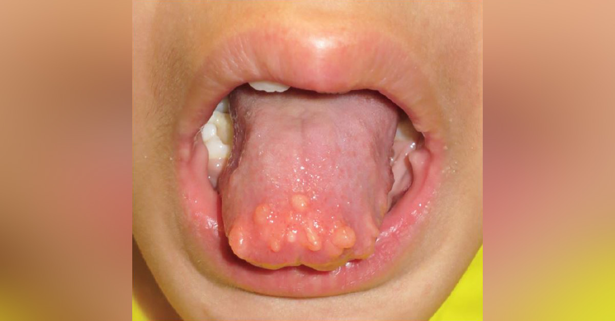 A Child With A Growing Nodule On The Tongue