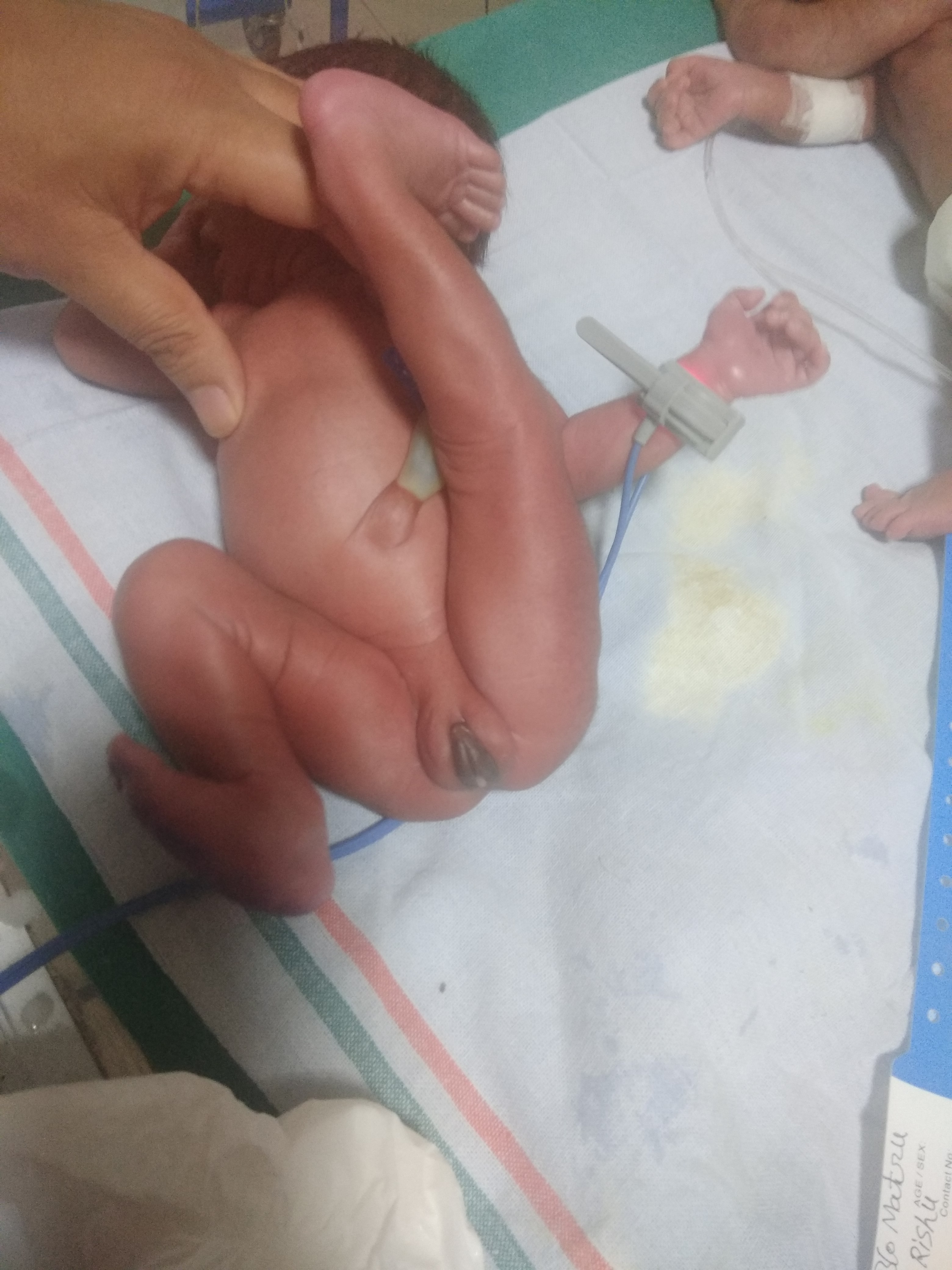 Congenital Genu Recurvatum