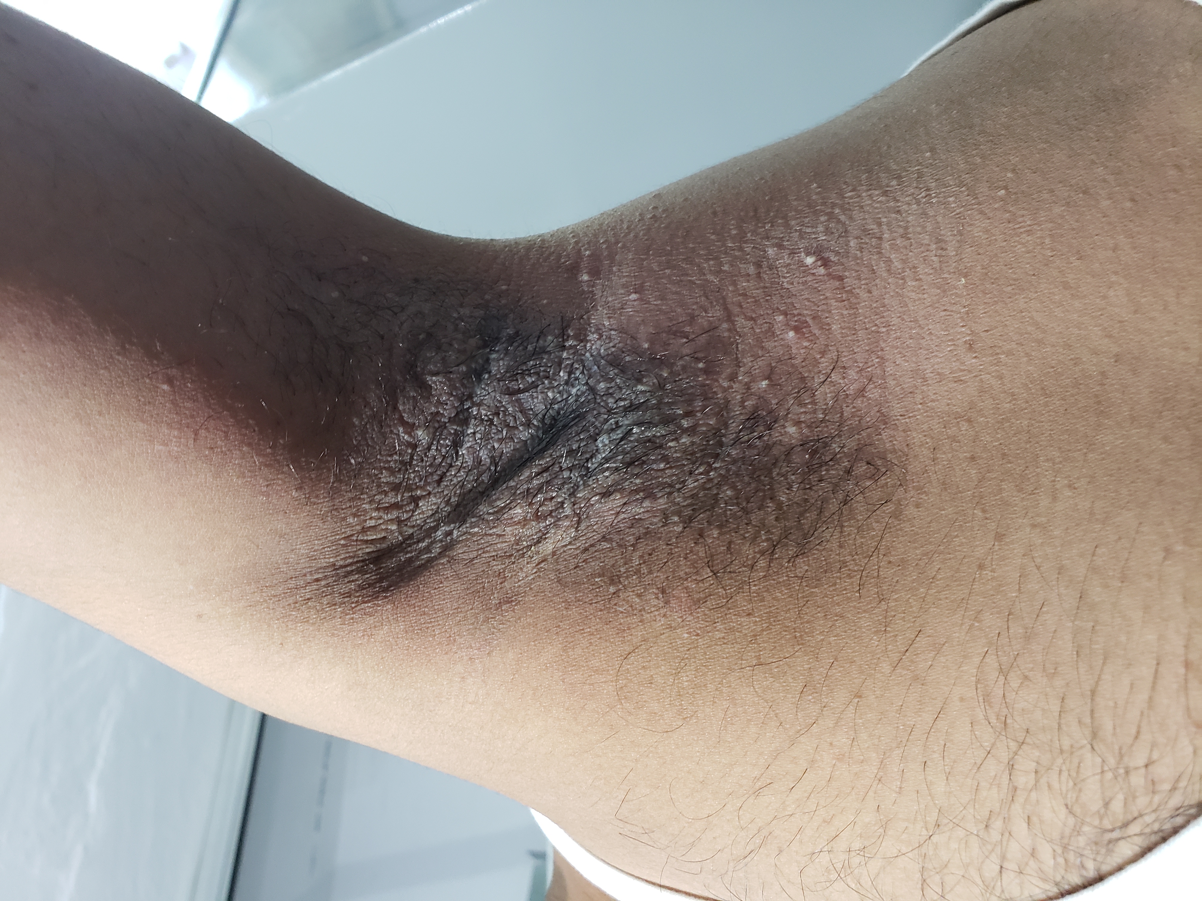 Can These Skin Lesions Be Also Result Of Fix Drug Eruptions?