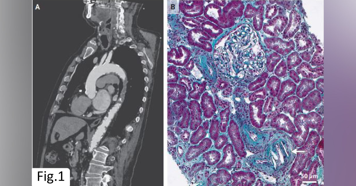 An Elderly Man With A High Level of Serum Creatinine