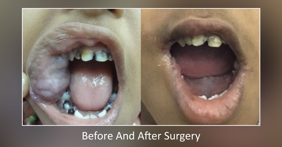 Cavernous Hemangioma Of The Lip