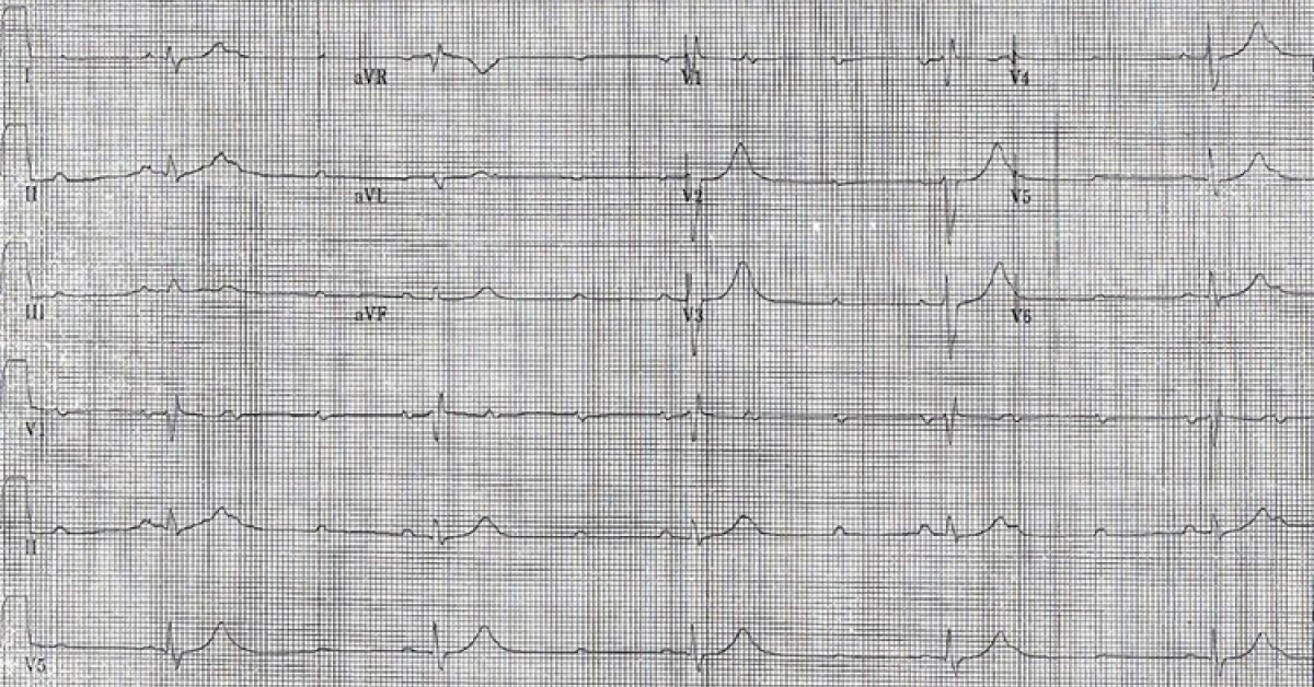 An Elderly Man With The Sensation Of Presyncope