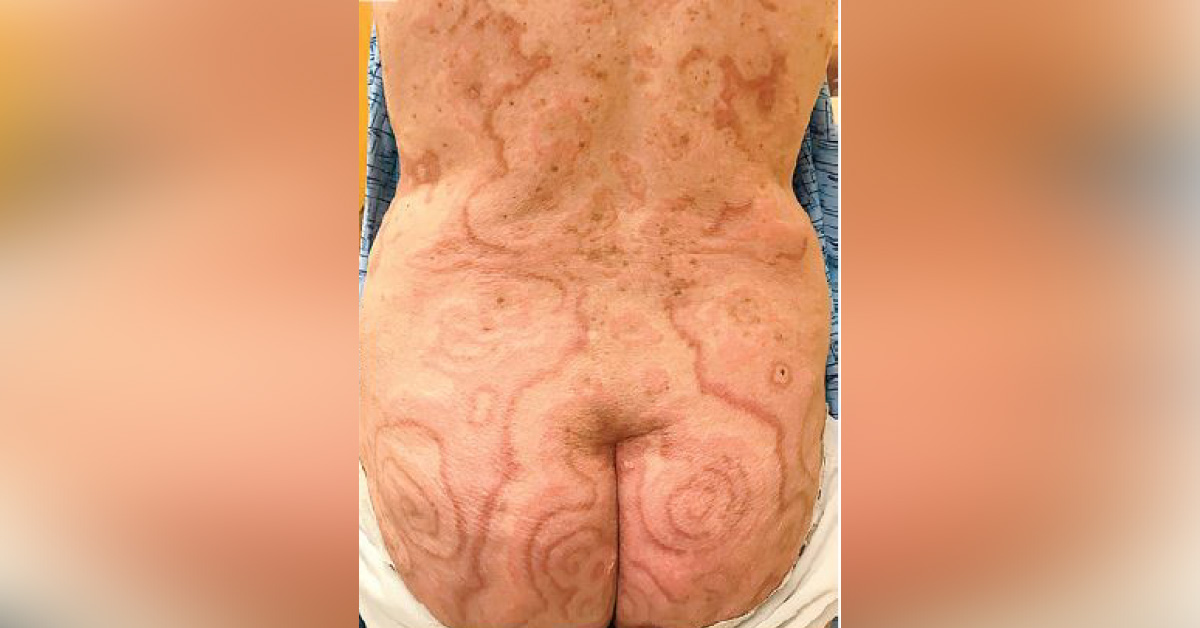 A Geriatric Patient With Rash Throughout The Body