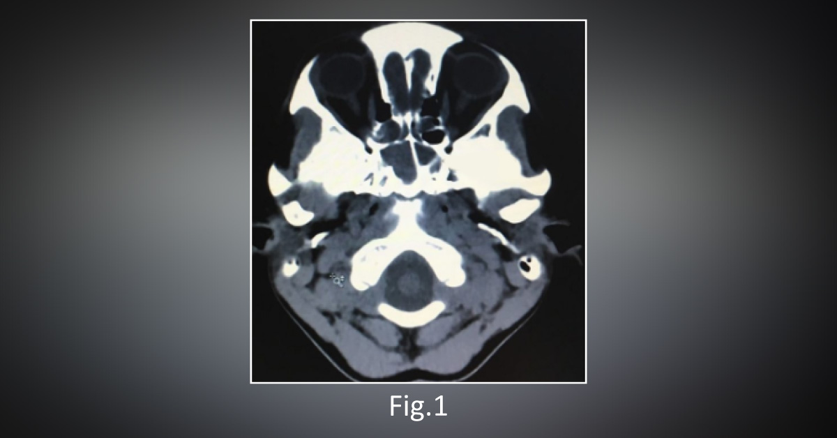 An Unusual Case of Sphenoid Sinusitis Mimicking Meningitis