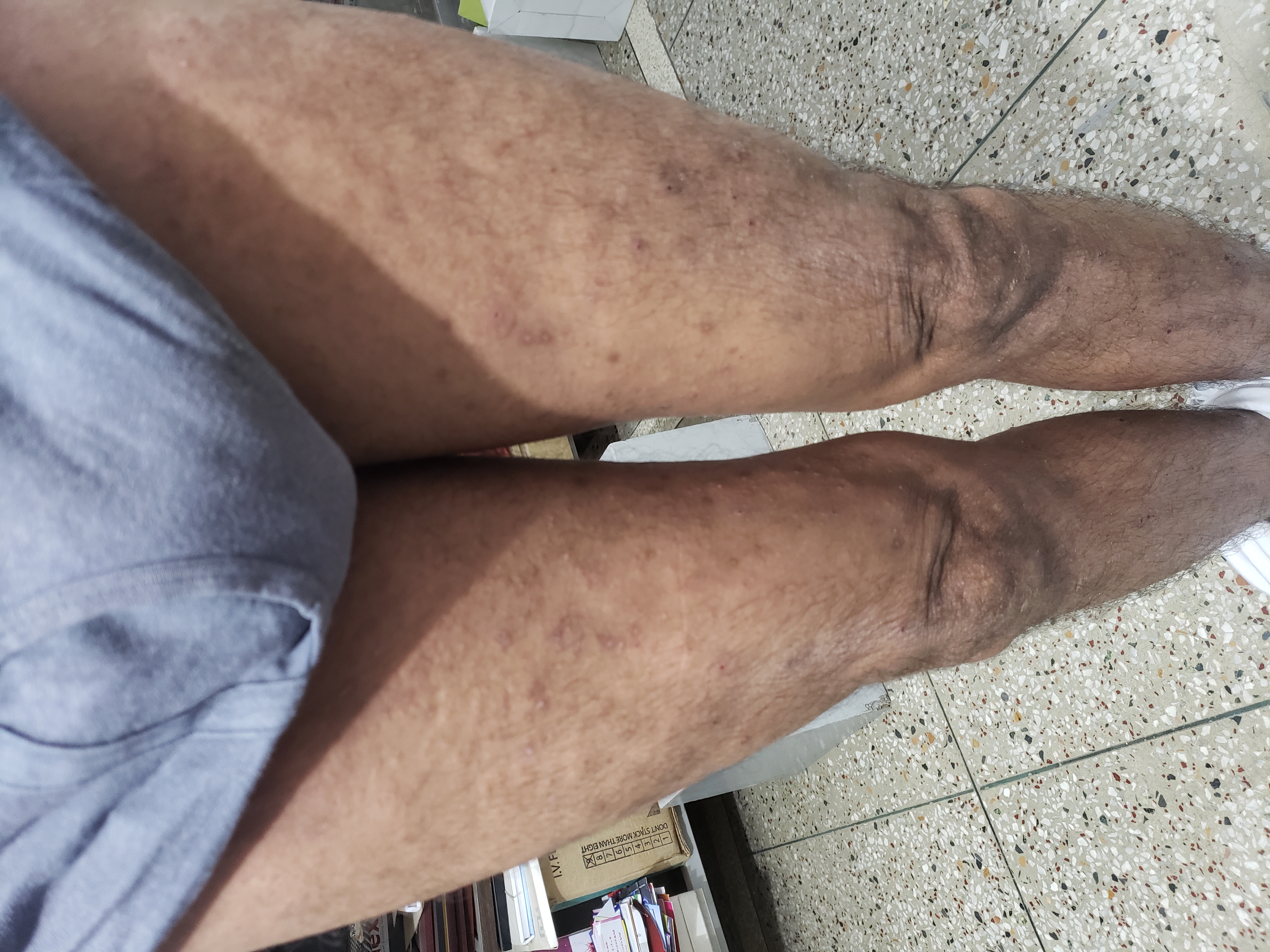 What is the treatment of this non responding Tinea corporis in an Alcoholic patient?