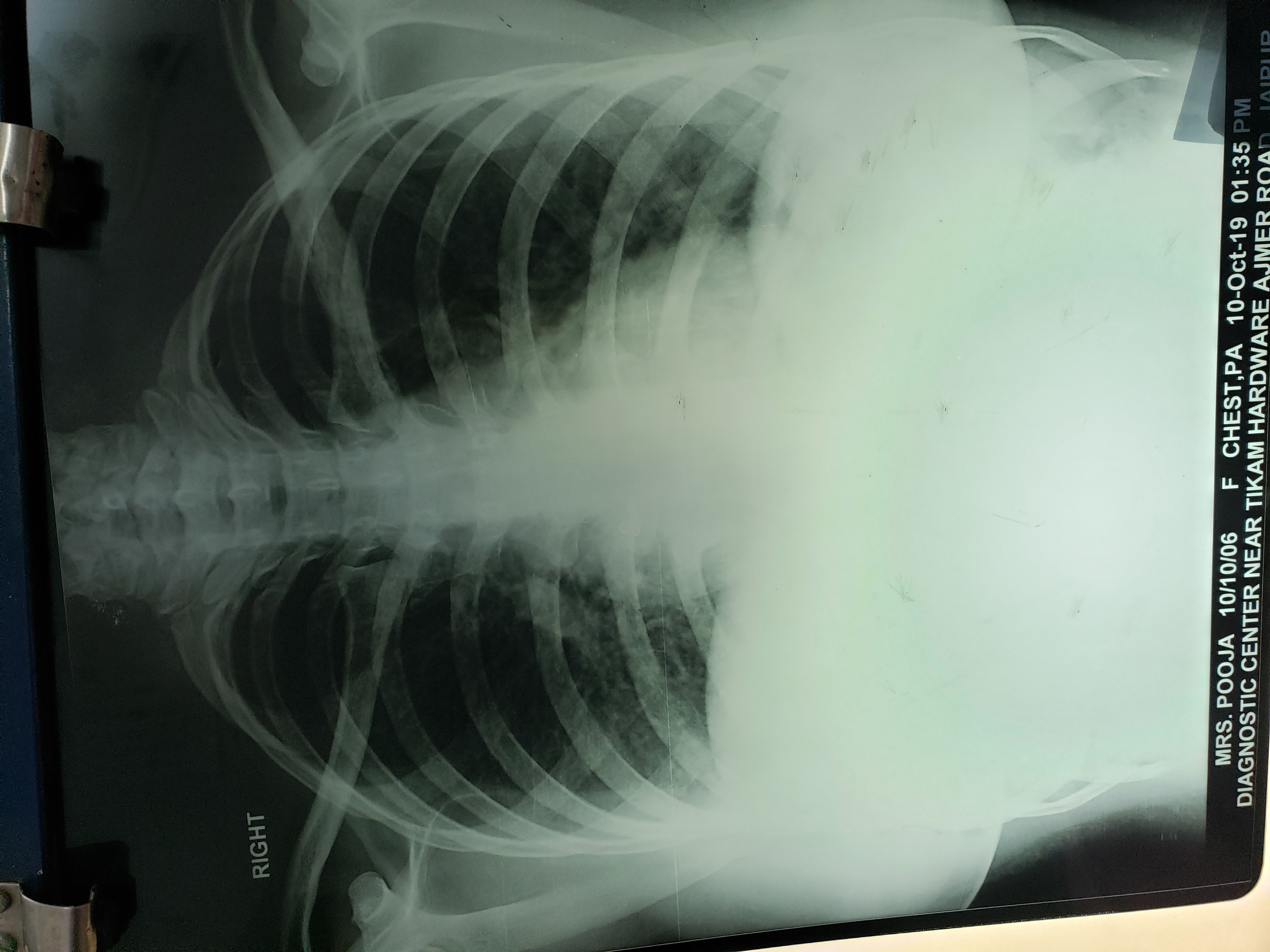 What Is The Cause Of Pain At Rt Chest At Anterior Axillary Line At Level Of Hepatic Area?