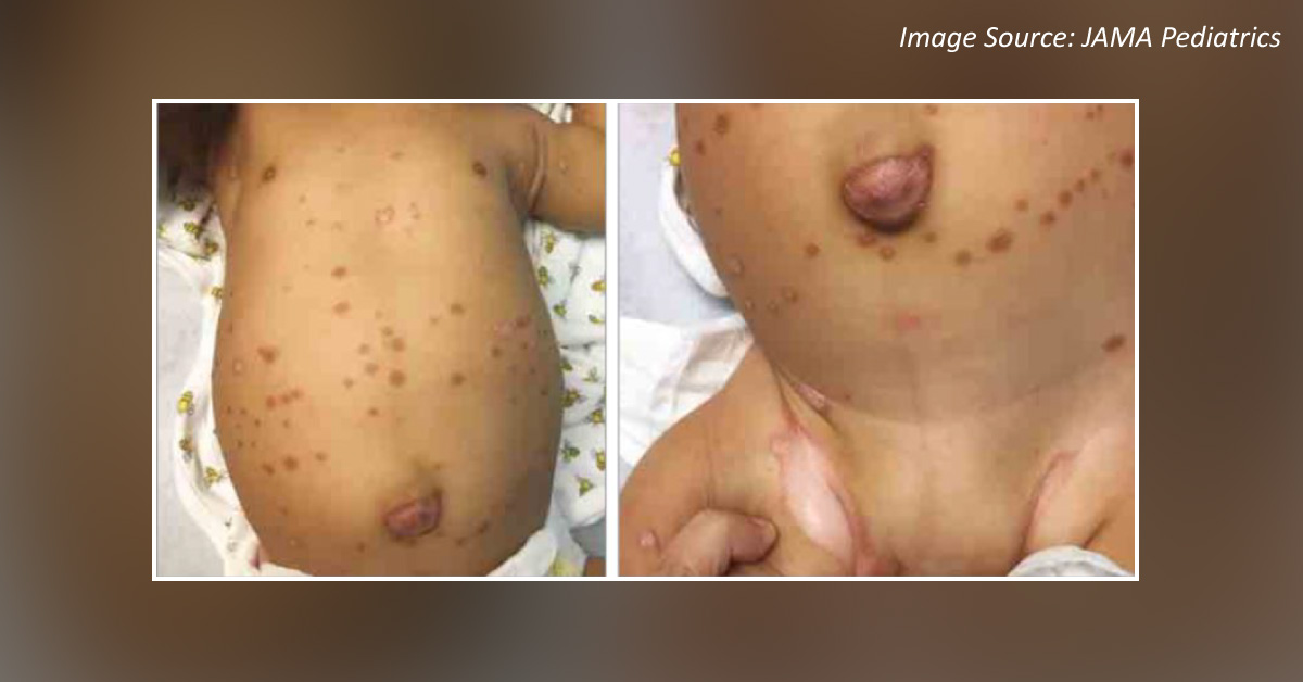 A 2-month-old Baby with Nummular Patches and White-colored Plaques on His Body