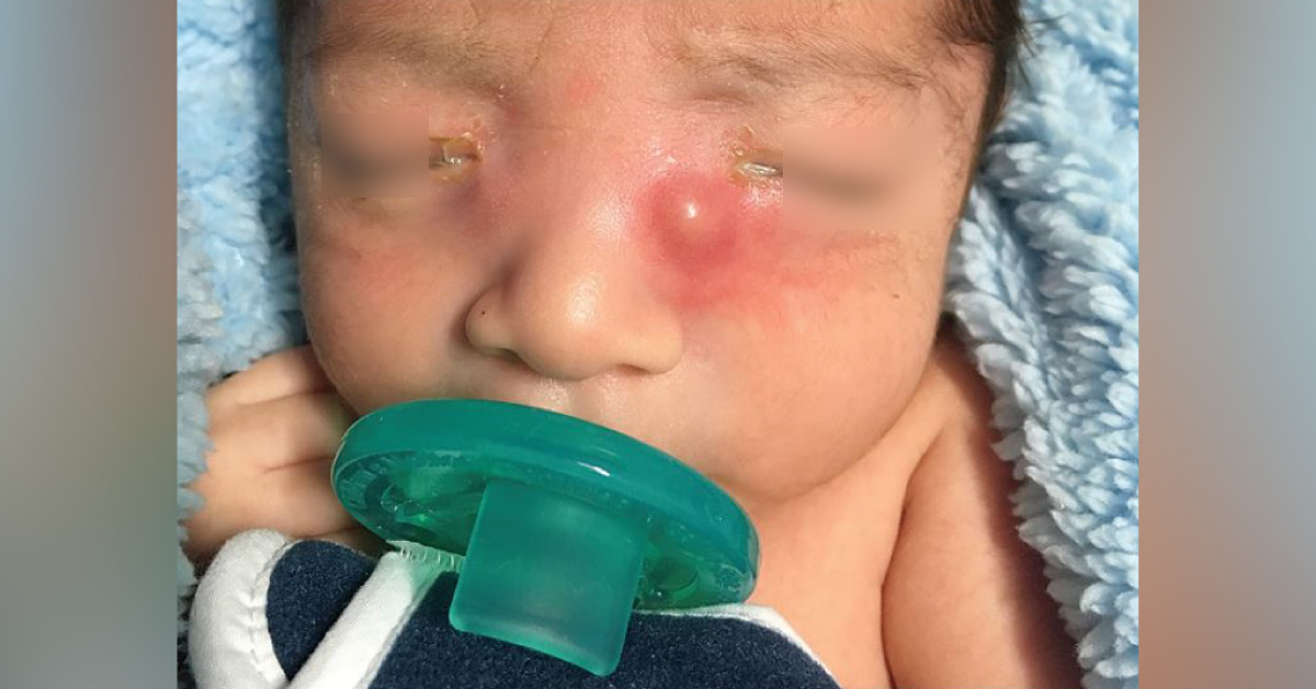 A Newborn with Purulent Discharge from Eyes