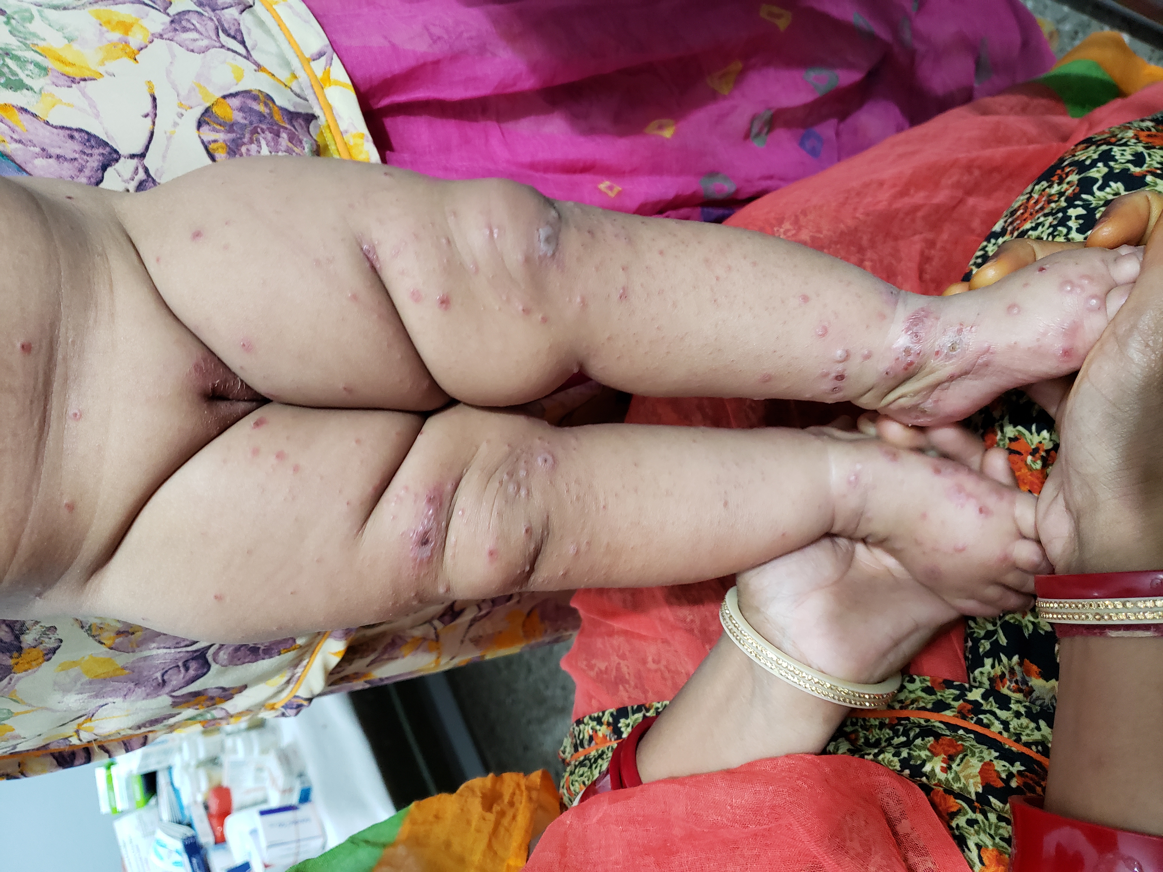 Is There Any Special Way To Treat Scabies In Infants?