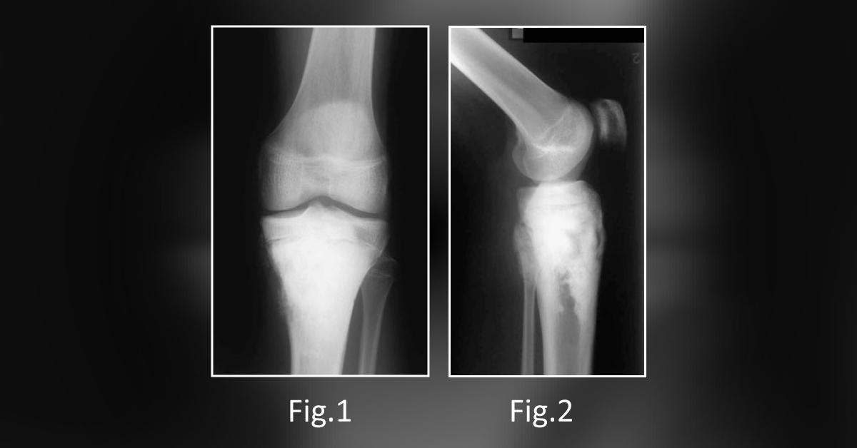 An Adolescent with an Expanding Mass in His Knee