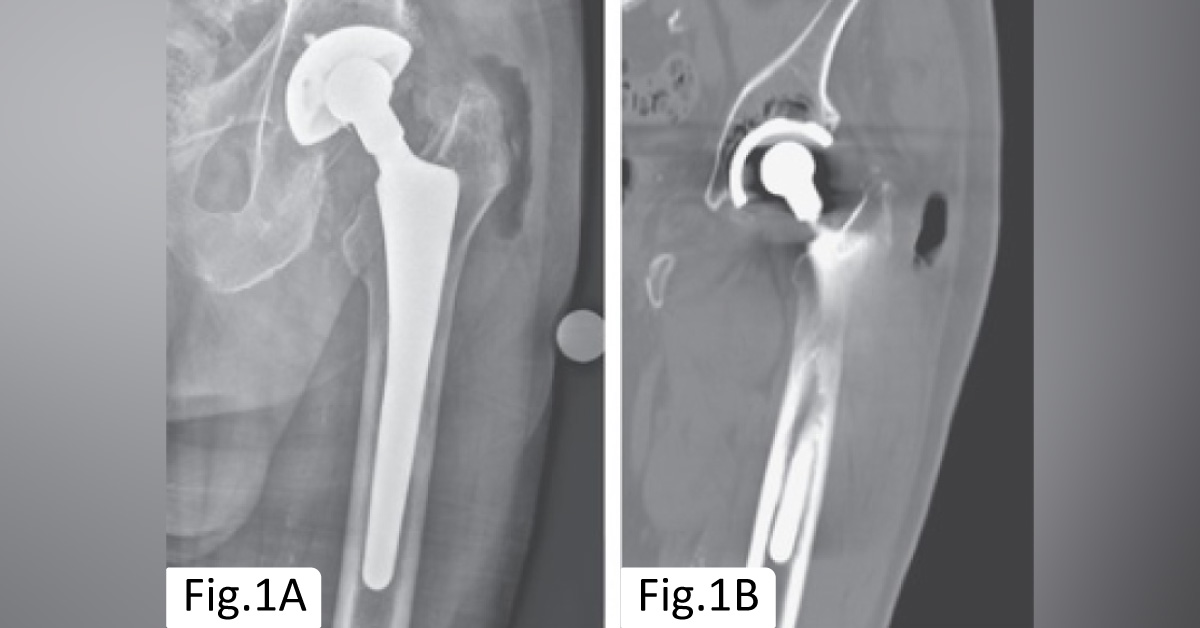 A Prosthetic Hip Causing Gas Gangrene In An Elderly Patient