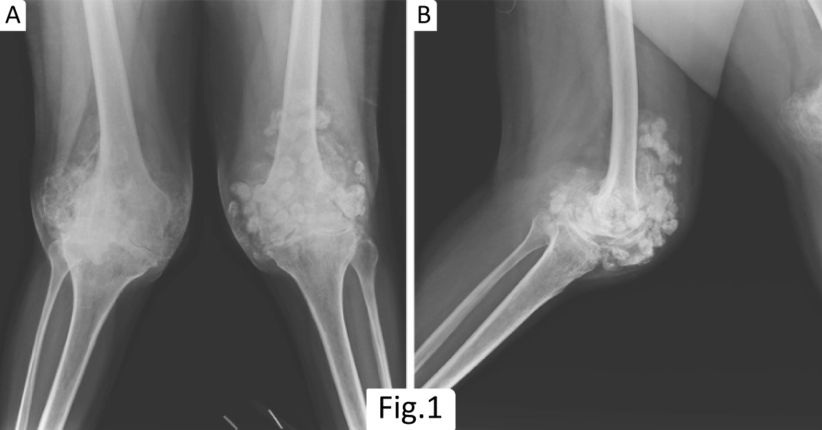 A Case of Difficulty in Walking with Worsening Knee Pain