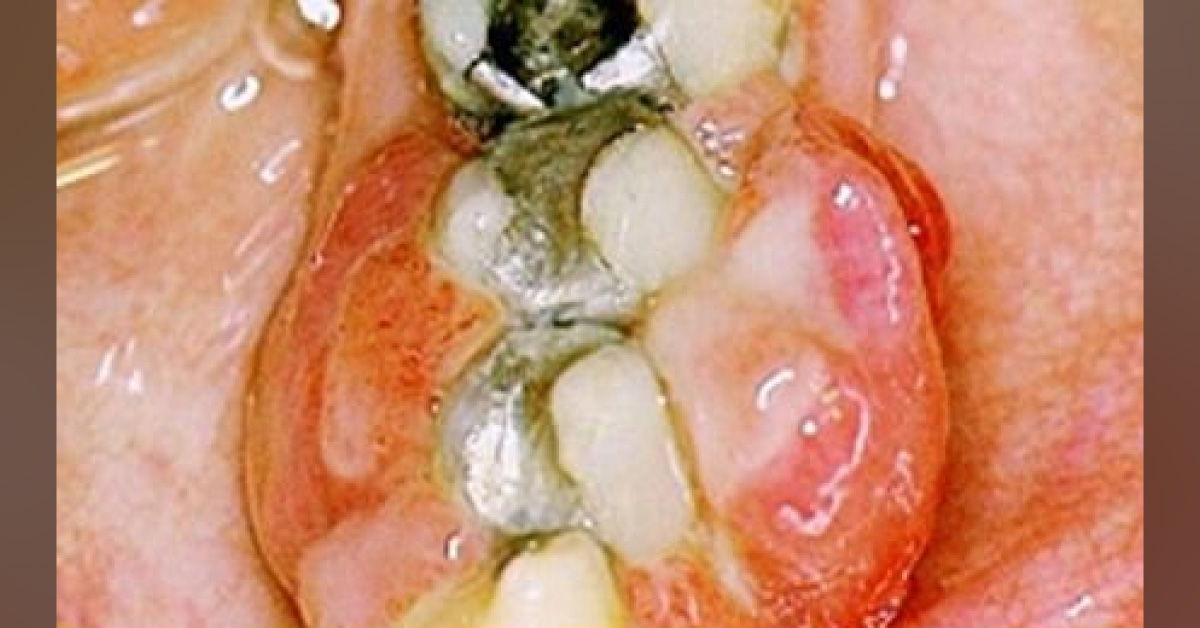 A Young Pregnant Woman With Swollen Gingiva