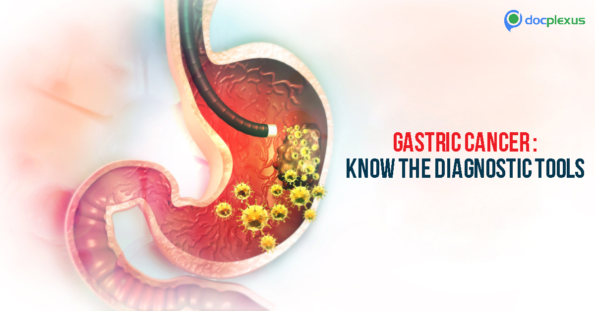 Diagnosis of Gastric Cancer