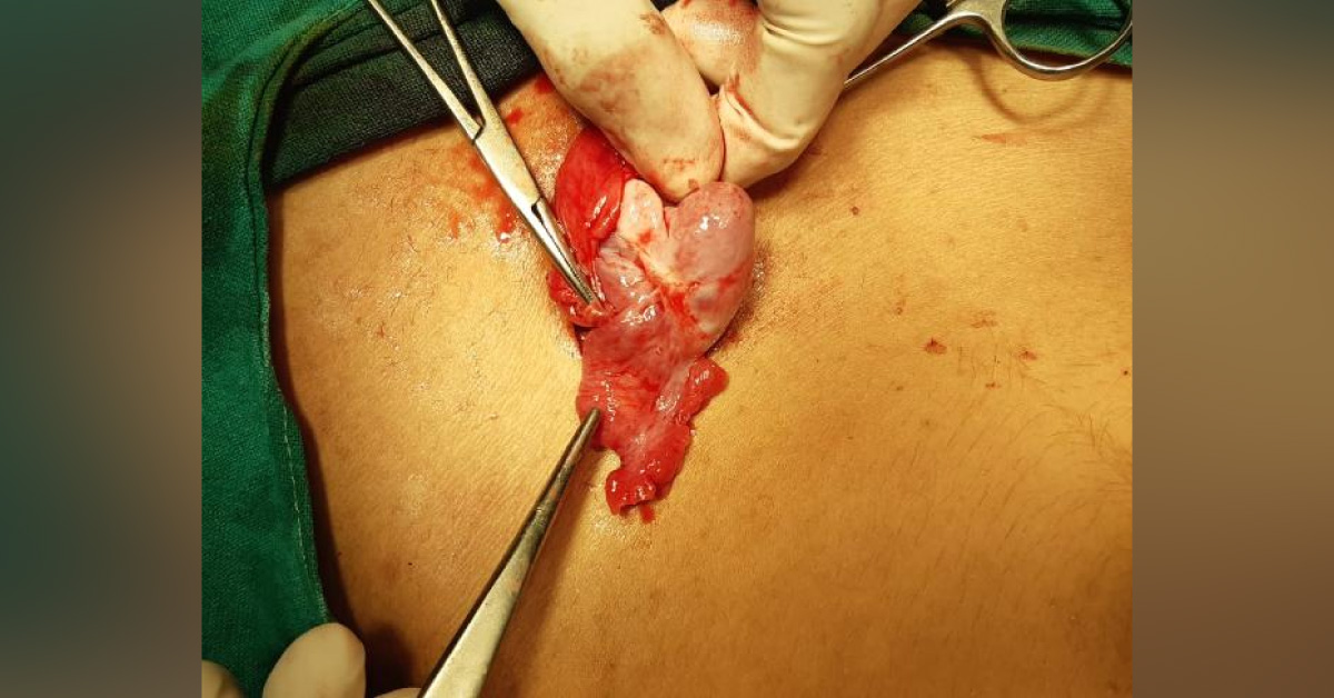 A Rare Case Of Inguinal Hernia