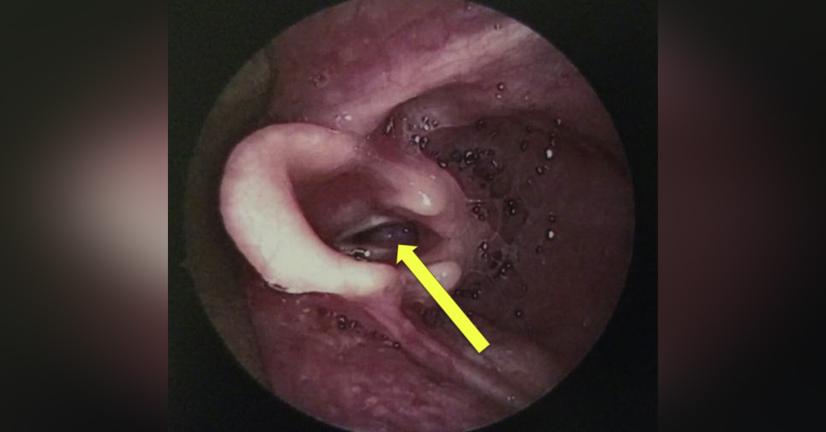 Case of an Infant with Acute Stridor