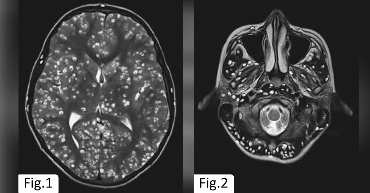 An Elderly With Generalized Seizure