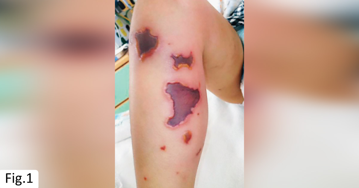 A Toddler with Severe Skin Lesions