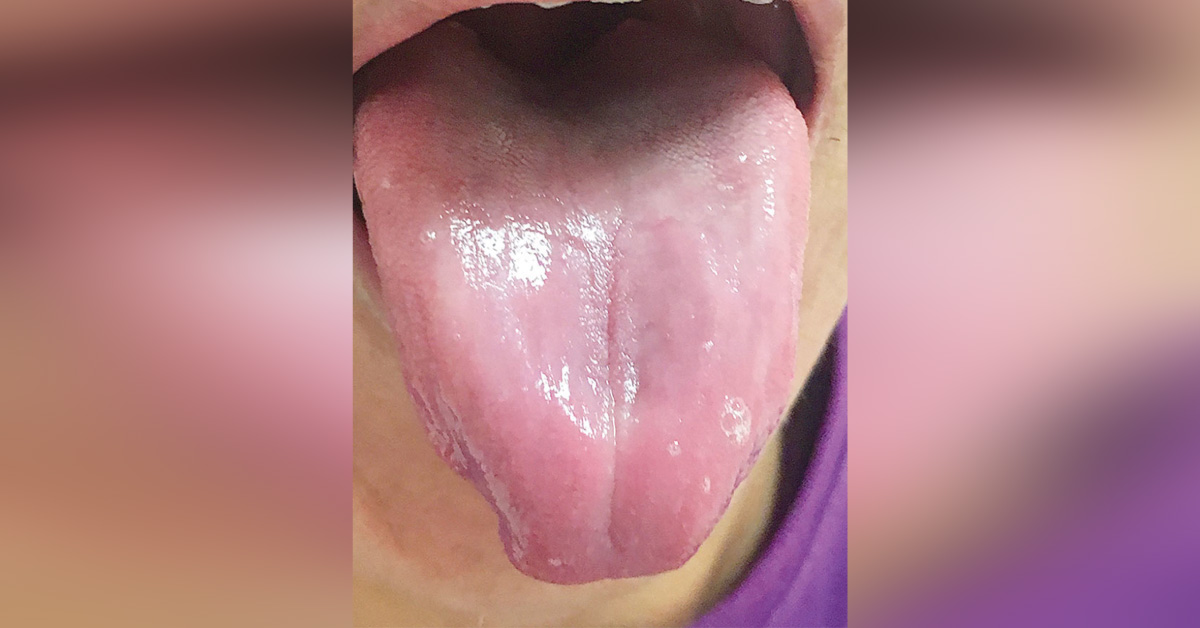 An Elderly Man With a Painful Tongue