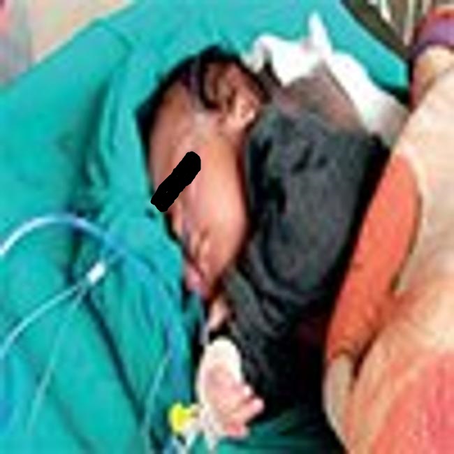 3.5 Kg Tumour Attached To Infant Girl's Head, Was Removed In NCH, Gujarat