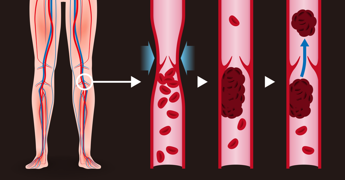 Risk Factors And Treatment For Thrombosis