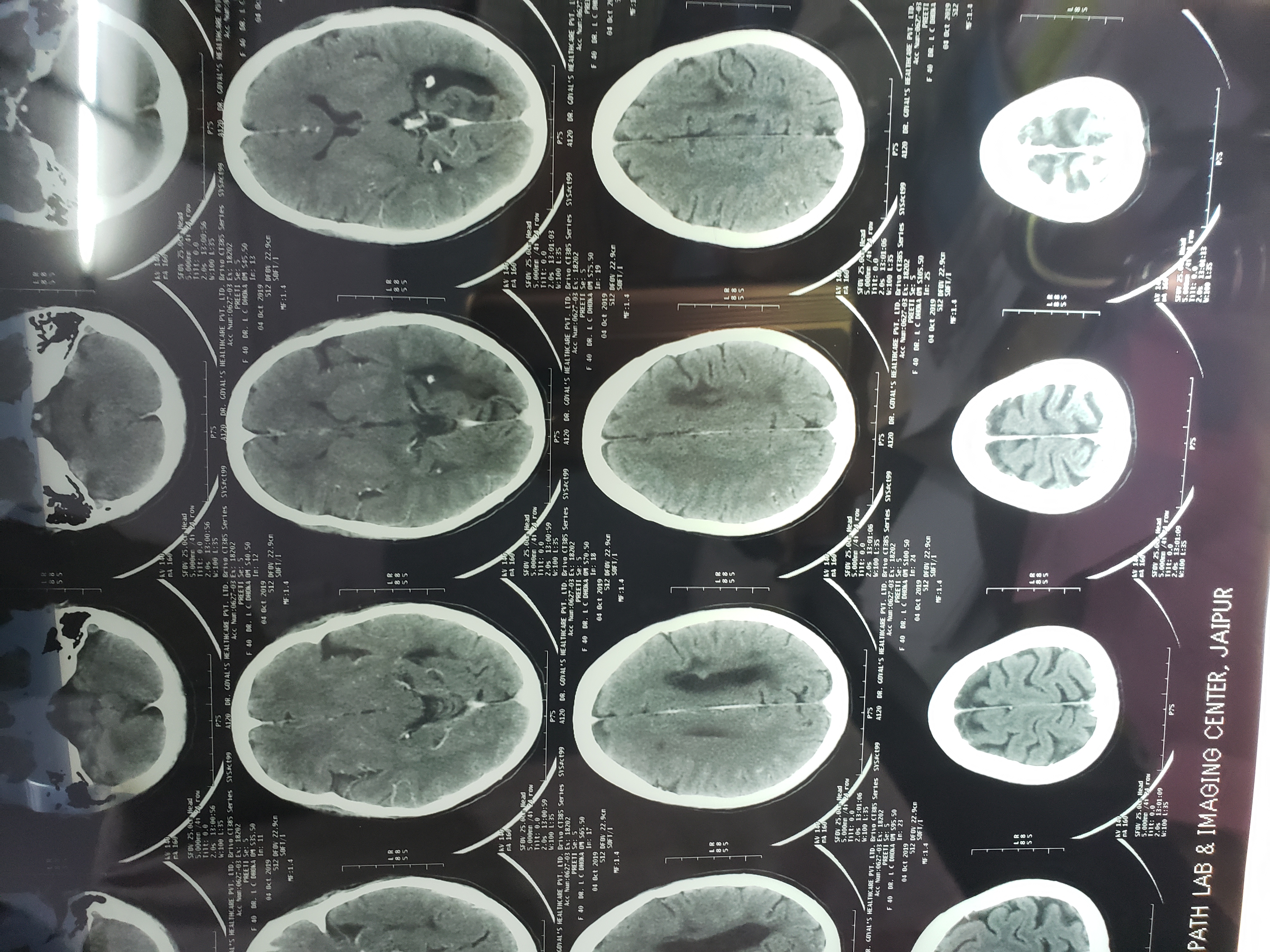Is There Any Recent Advance In Treatment Of Encephalomalacia Nowadays?