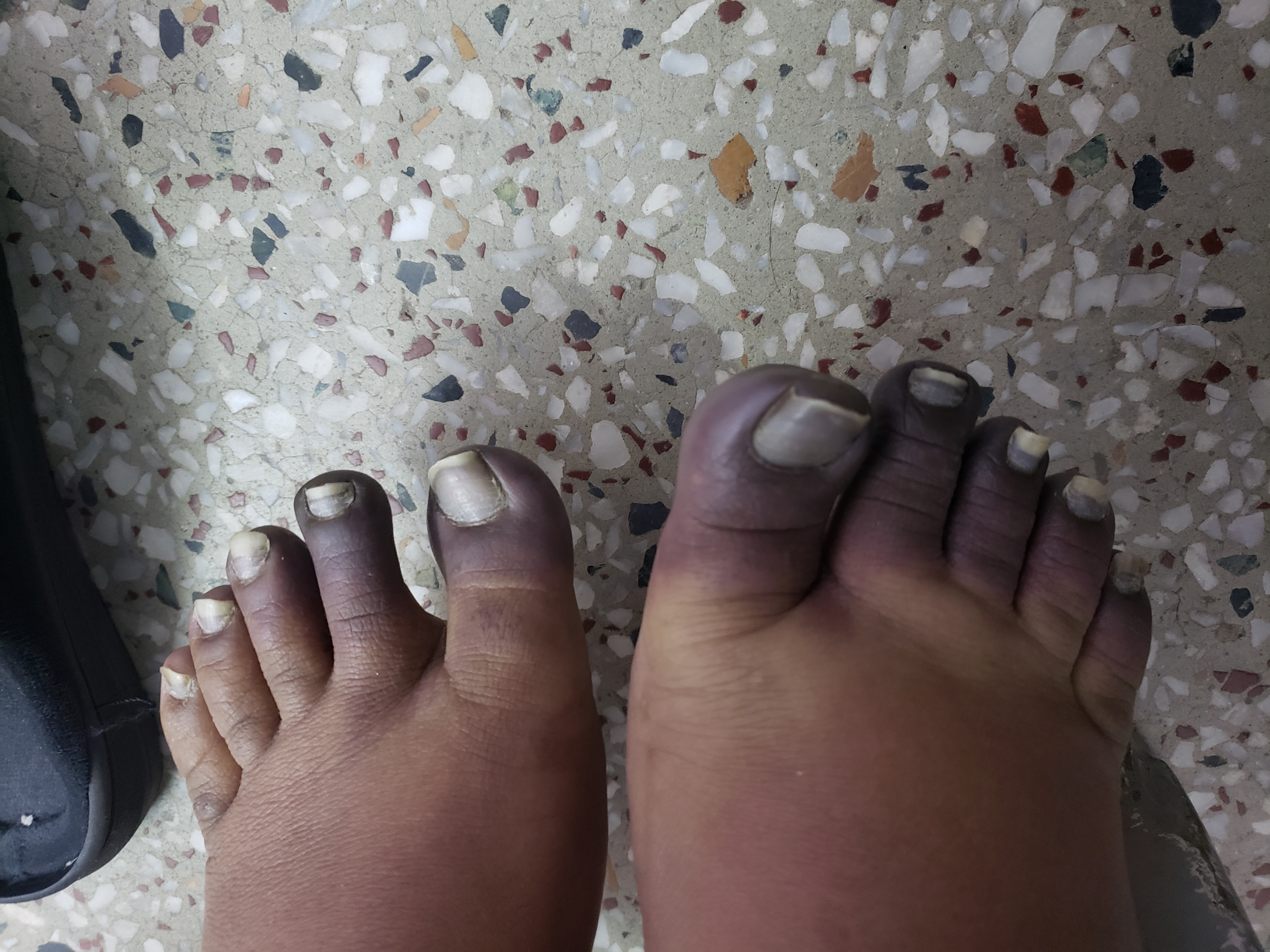 Diagnosis Of This Girl's Feet Condition