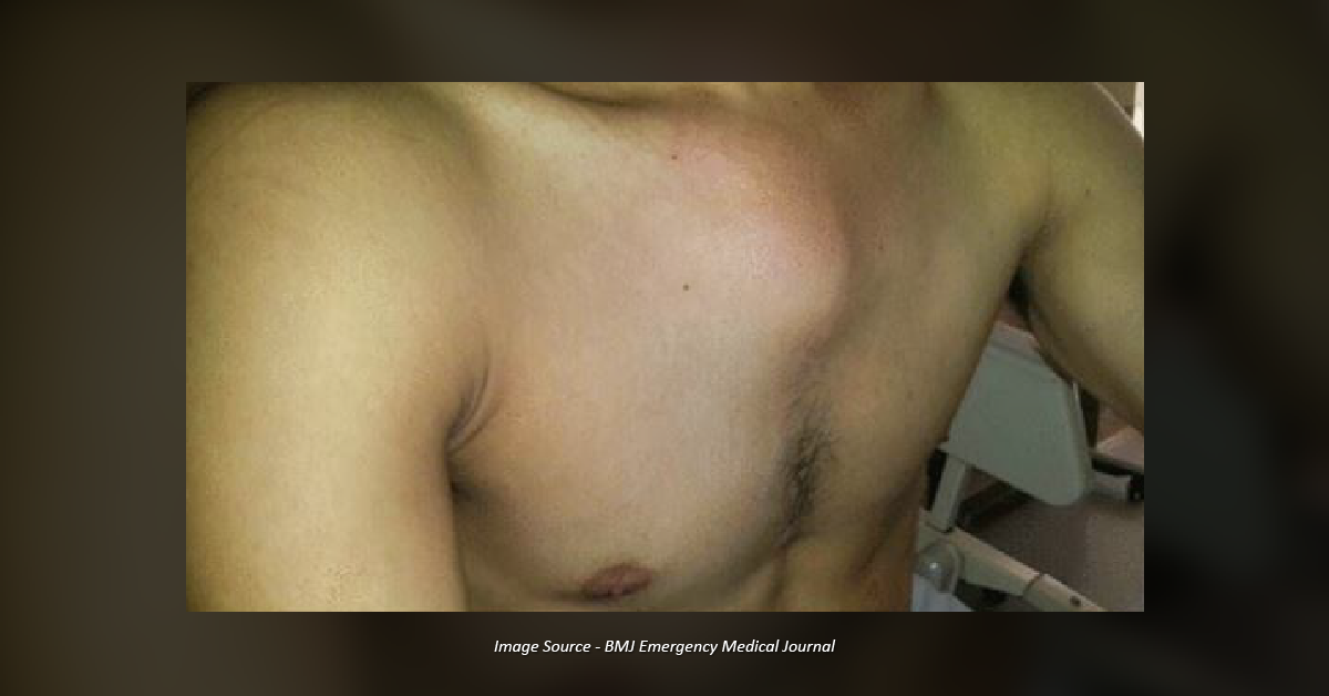 Diagnose The Chest Mass In Young Patient