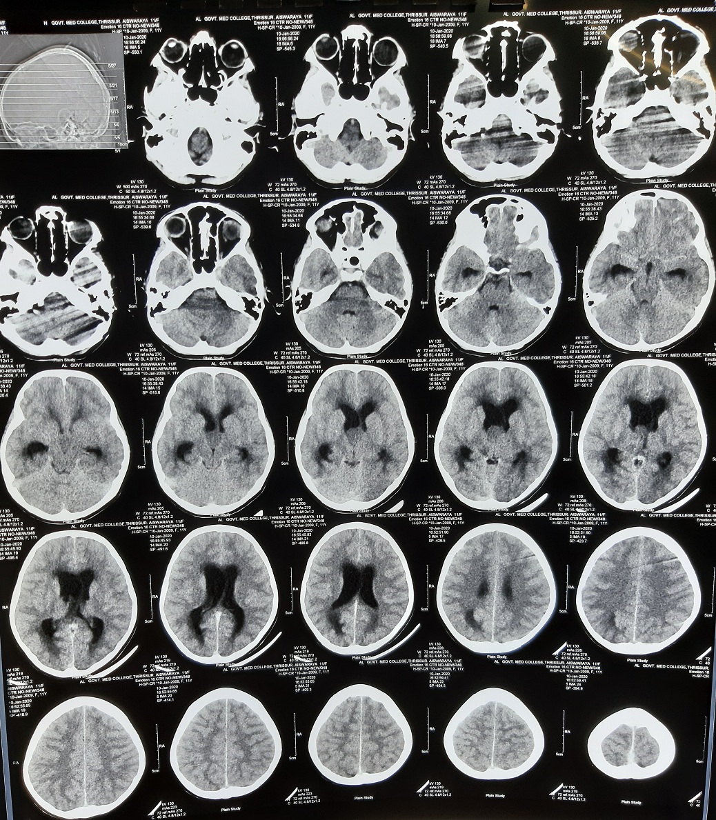 Child With Fever Headache And Vomiting