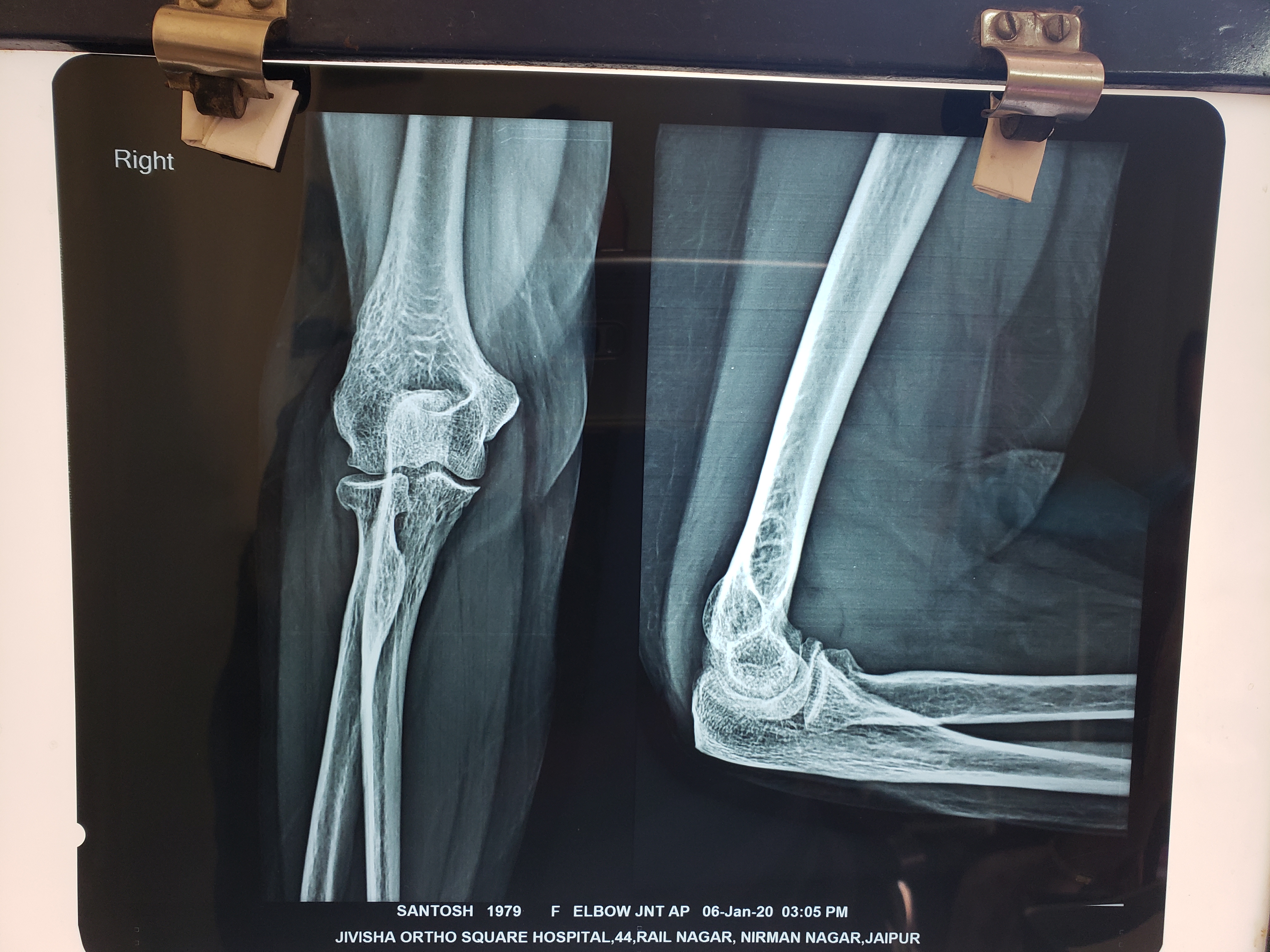 What Are The Observation In This Elbow X Ray (Rt)?