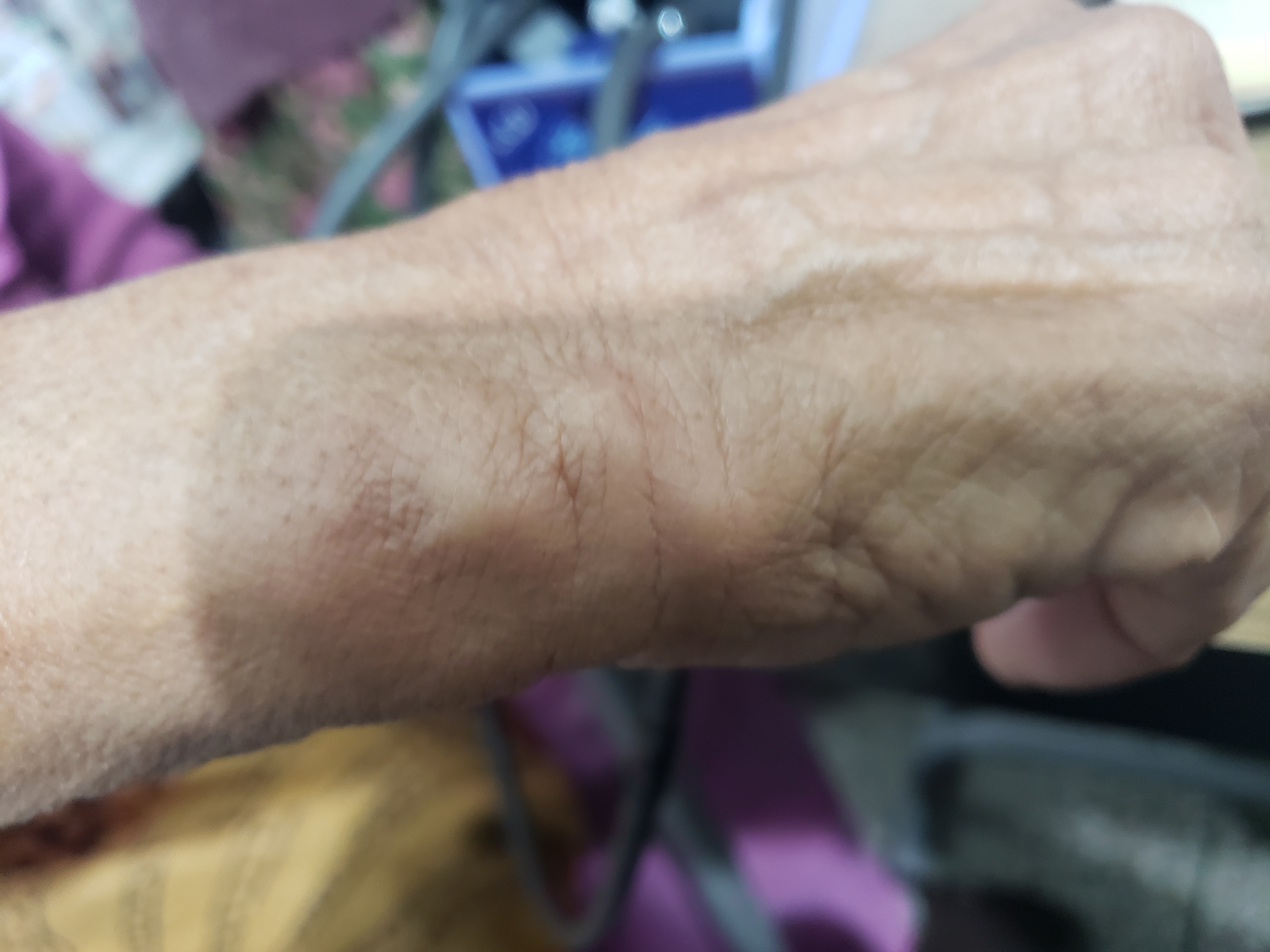 What Are These Nodules At Wrist And Forearm?