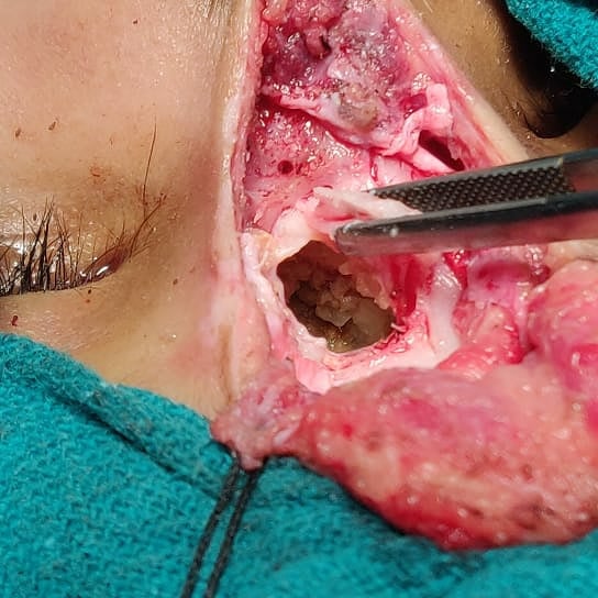 Nasal Dermal Sinus With Dermoid, What Is The Role Of Neurosurgeons