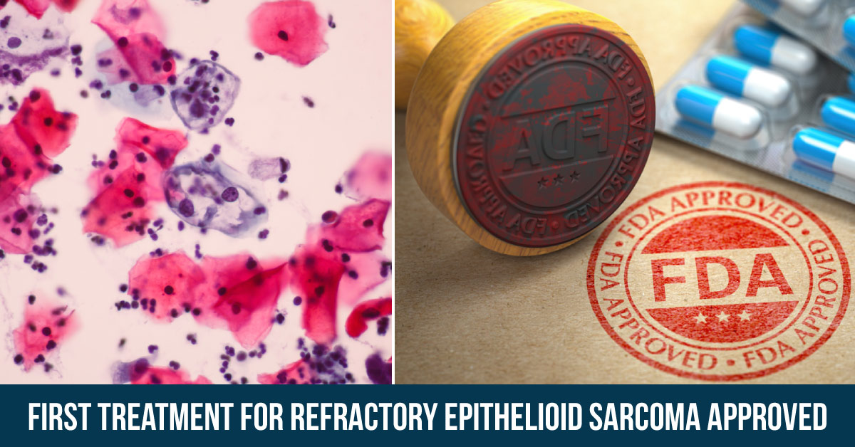 FDA Approves First Treatment For Epithelioid Sarcoma