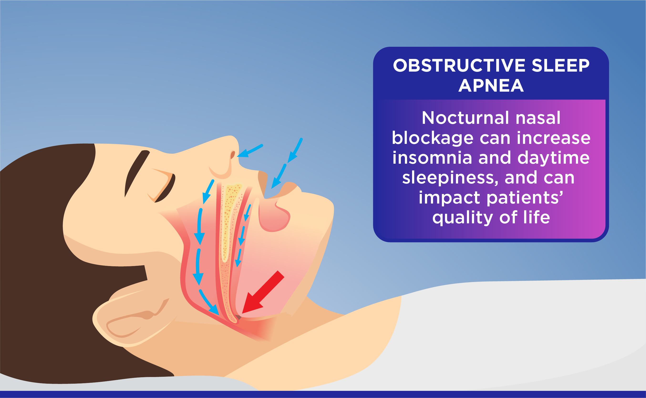 Nasal Obstruction At Night And Its Health Impact In Patients With Obstructive Sleep Apnea
