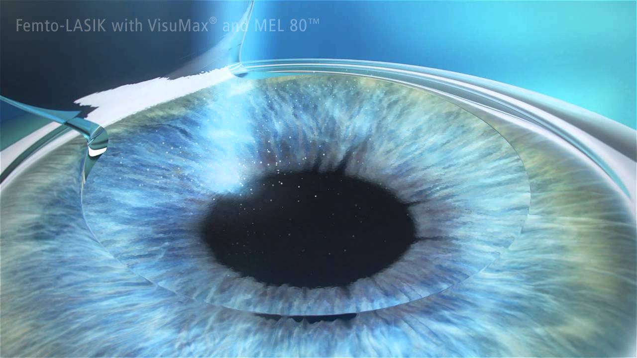 What Is Femto Lasik?