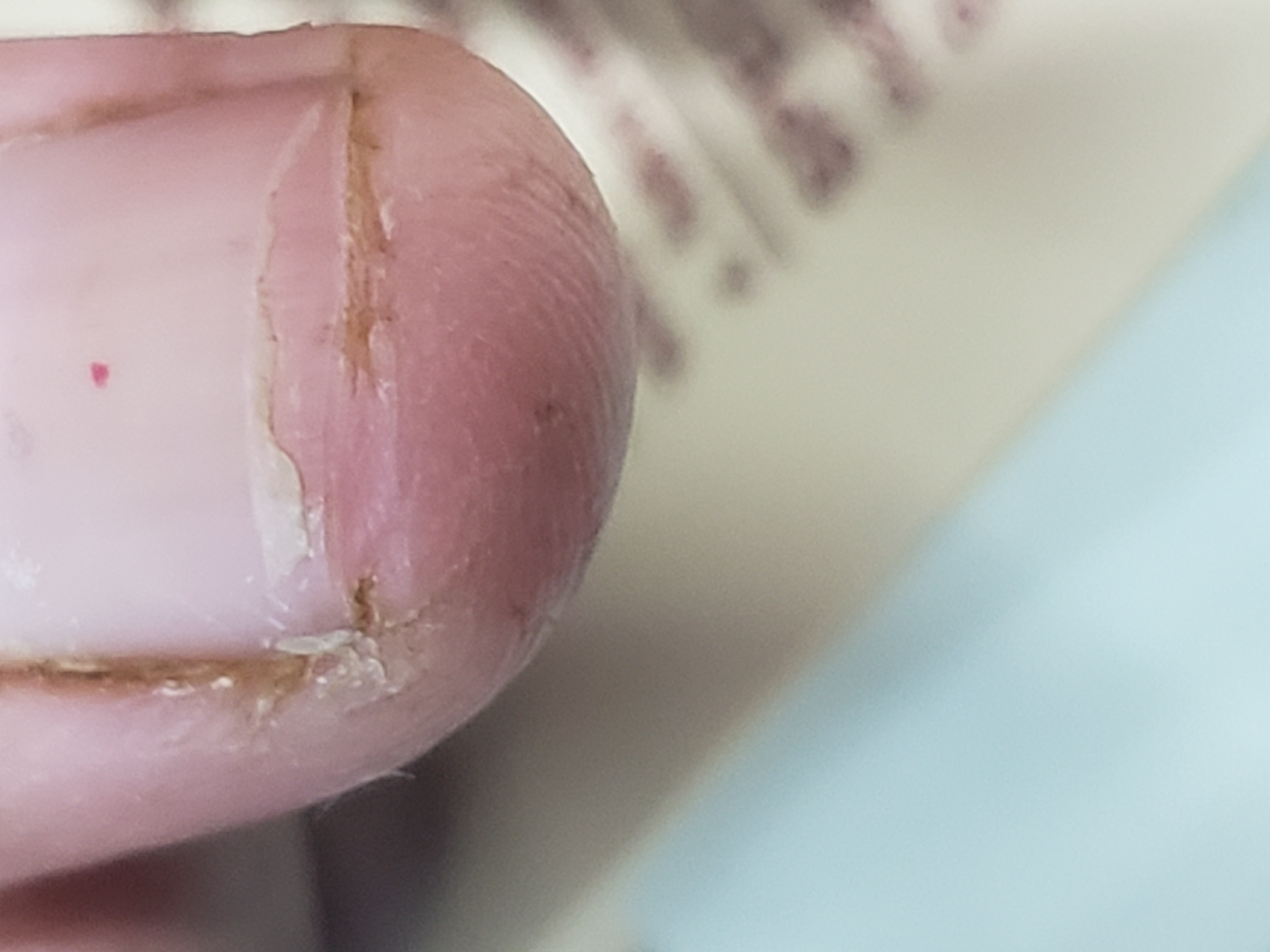 Splitting Of Nails In Layers