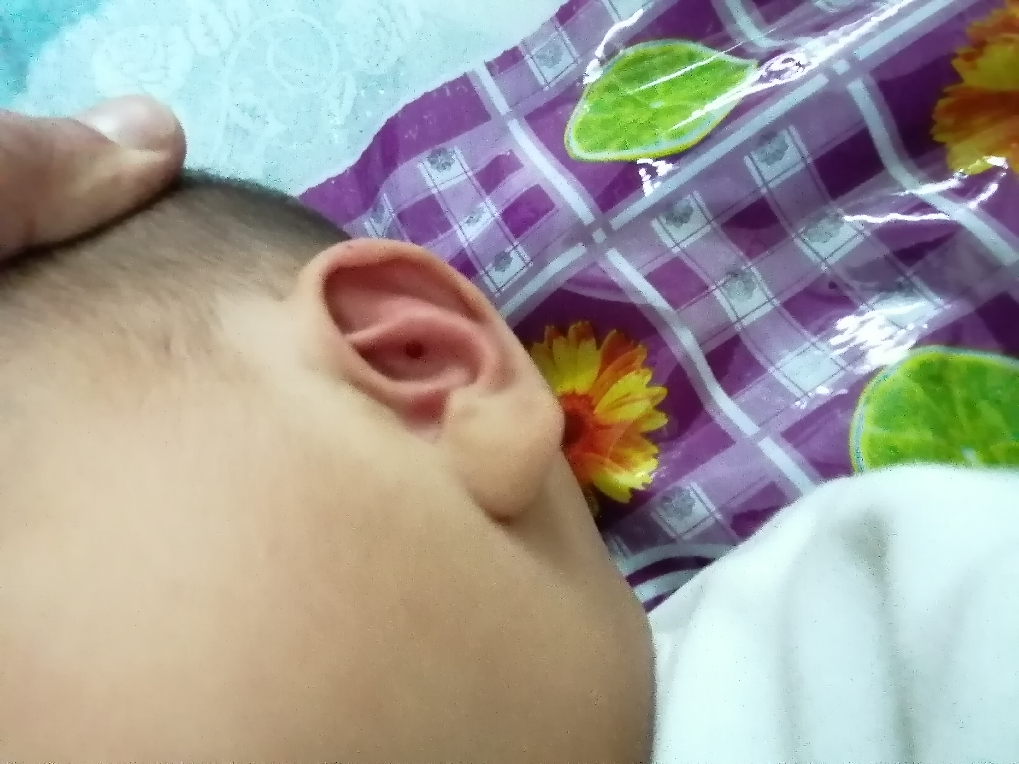 Bleeding Ear Pinna