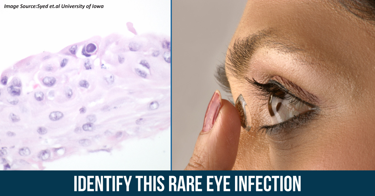 A Case of Rare Infection Due to Contact Lenses