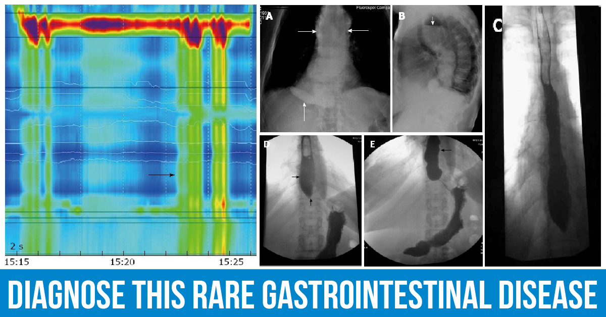 Diagnose This Case of a Rare GI Disorder with Nocturnal Cough