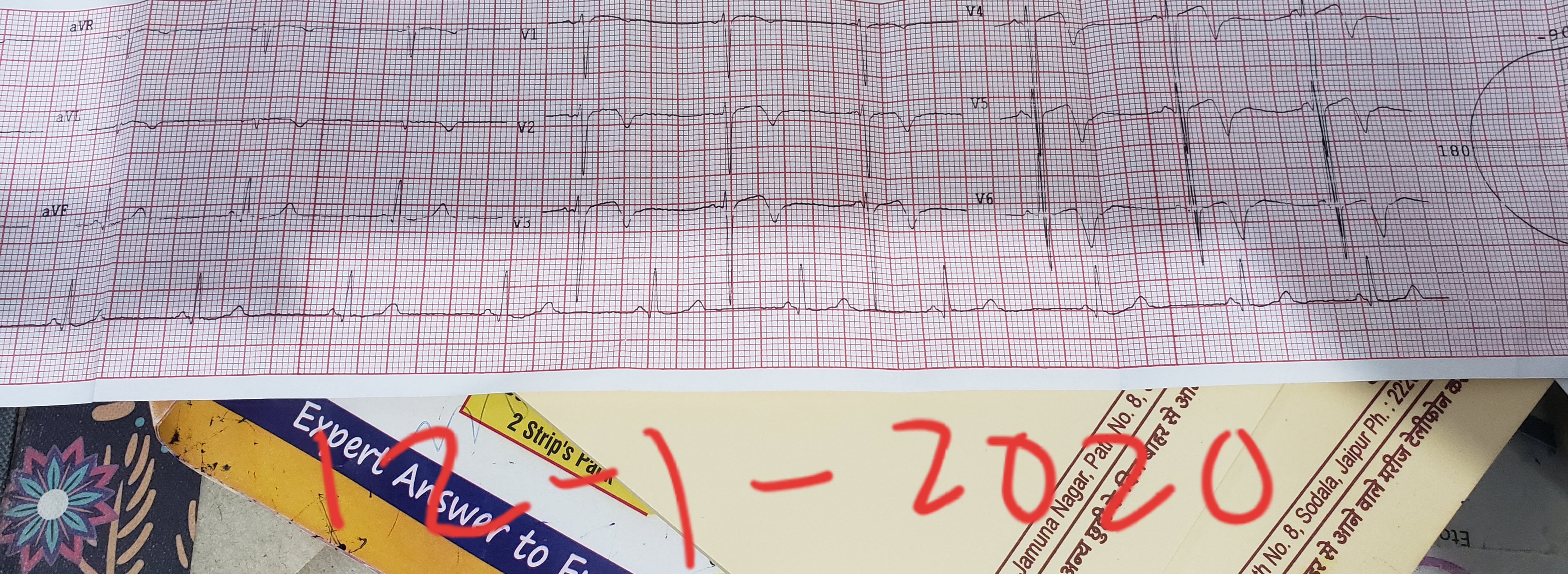 T- wave Changes Ignored At Town Level PHC, Imagine The Consequences
