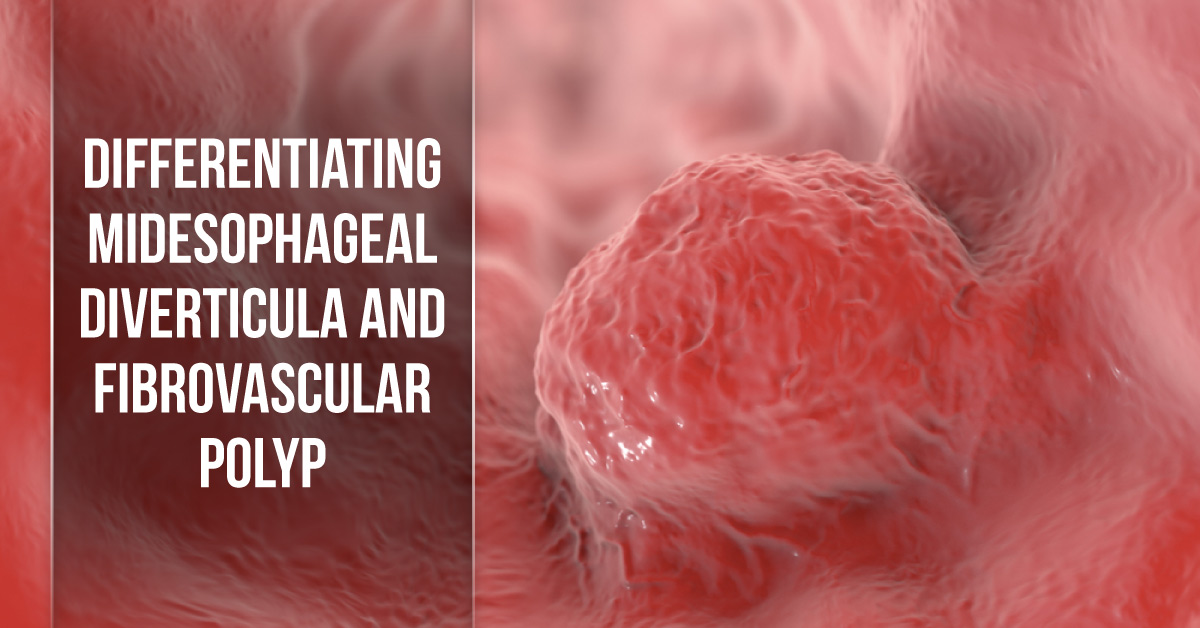 Differentiating Midesophageal Diverticula from Fibrovascular Polyps