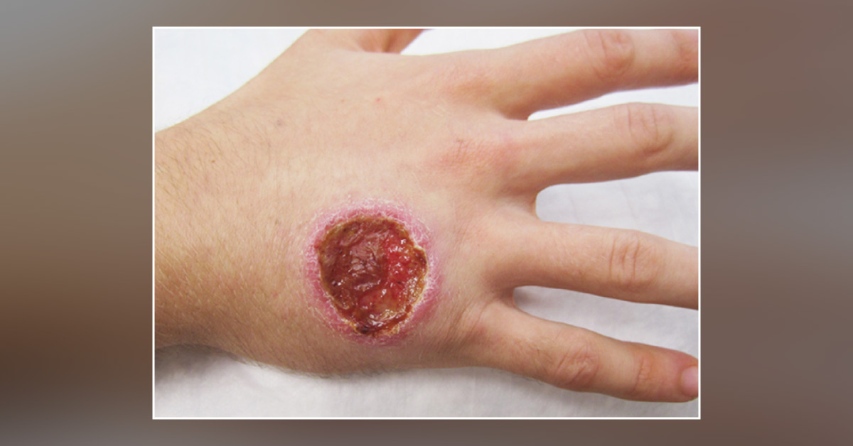 Diagnose This Case of an Enlarged Ulcer on the Right Hand