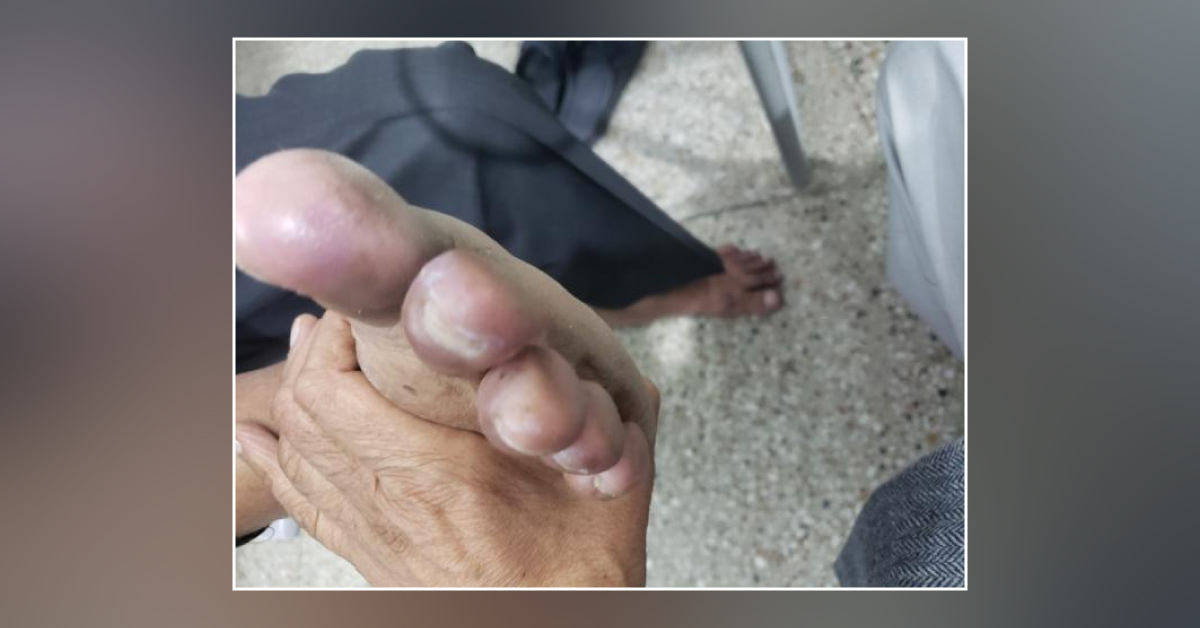 What Kind Of Cold Injury Is This? 