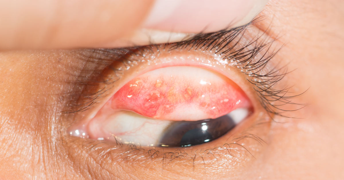 Ace This Case of Lacrimation in the Eyes
