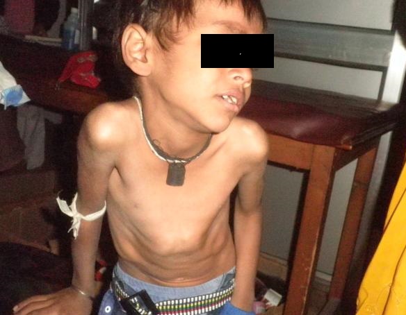 Case Of Tuberculosis In Six Year Old Children