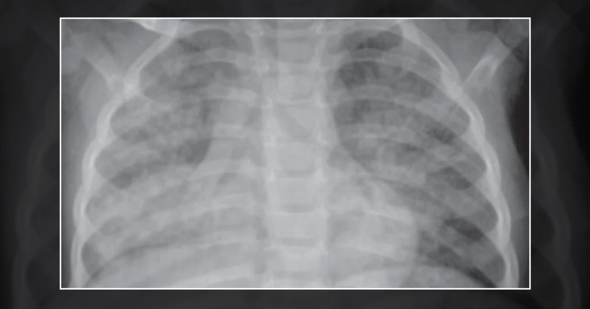 A Child with Unexplained Wheezing
